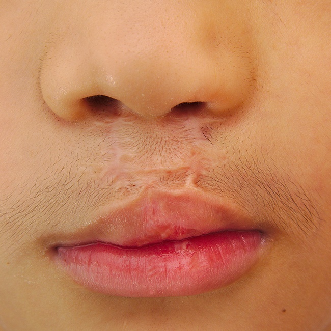 Closeup of patient with cleft lip and palate complications
