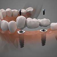 3D illustration of implant bridge replacing multiple missing teeth