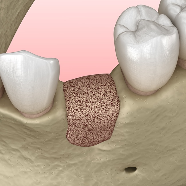 Animated smile after engineer tissue and bone grafting