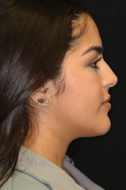 Side view of patient after orthognathic surgery