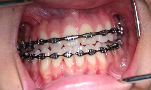 Closeup of patient's smile before orthognathic surgery