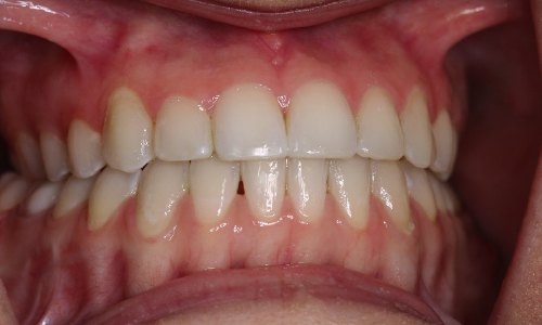 Closeup of aligned smile after orthognathic surgery