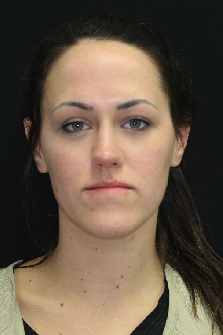 Front view of woman with crooked jaw before orthognathic surgery