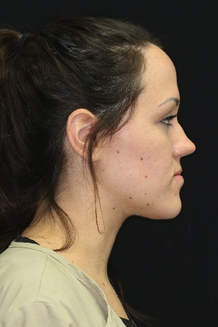Side view of woman with crooked jaw before orthognathic surgery