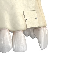 Illustration of block bone graft to prepare for dental implants
