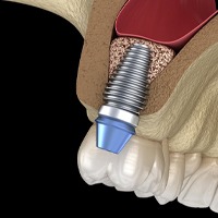 Dental implant in upper jaw after sinus lift procedure