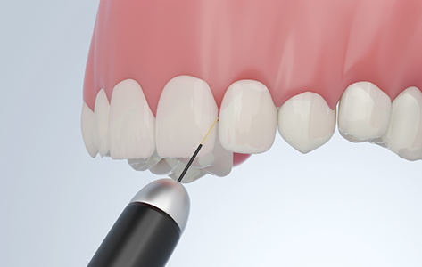 Illustrated laser treating the gums