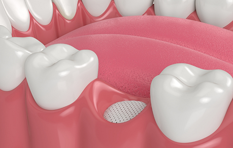 Illustration of bone grafting material in the socket after a tooth extraction
