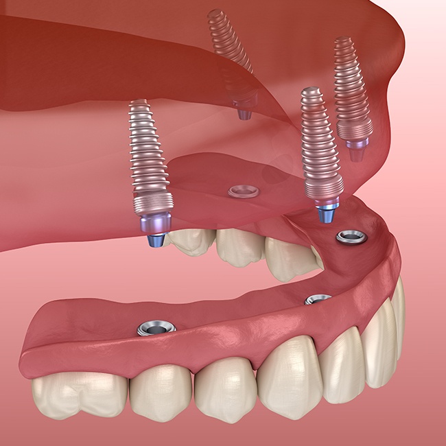 Animated smile with all on 4 dental implant supported denture