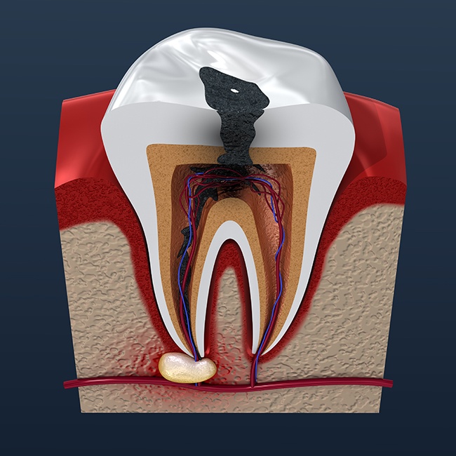 Infected and decayed tooth in need of apicoectomy surgery