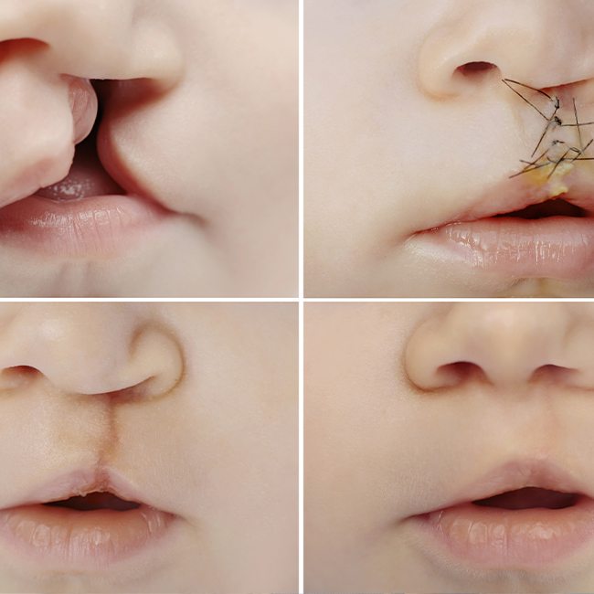 Closeup of smile at all stages of the cleft lip and palate surgery process