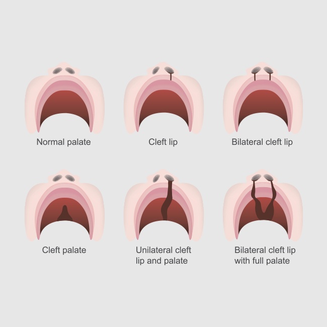 Image showing different types of cleft lip and palate