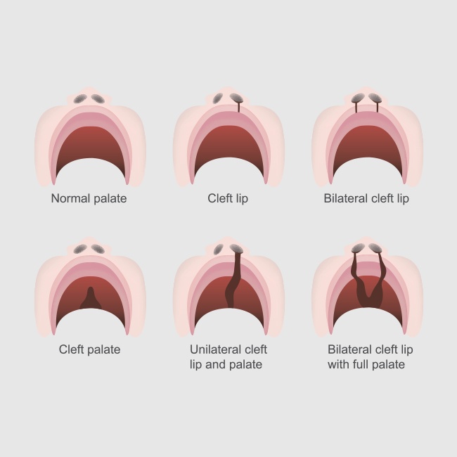 Cleft Palate Types
