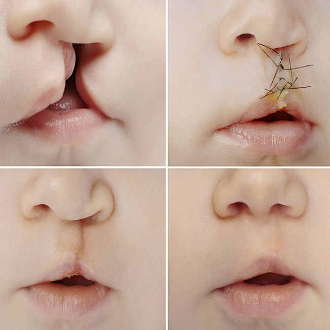 Images showing the phases of cleft lip and palate treatment