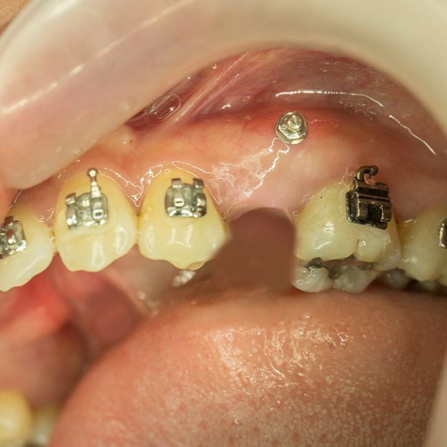 Closeup of smile before corrective jaw surgery