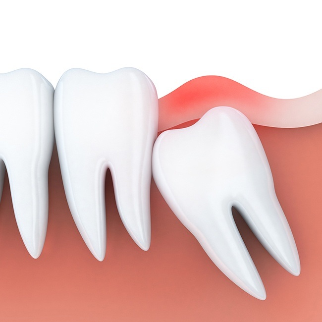 Animated smile with impacted tooth