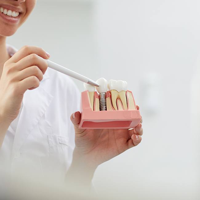 Model of dental implant supported dental crown