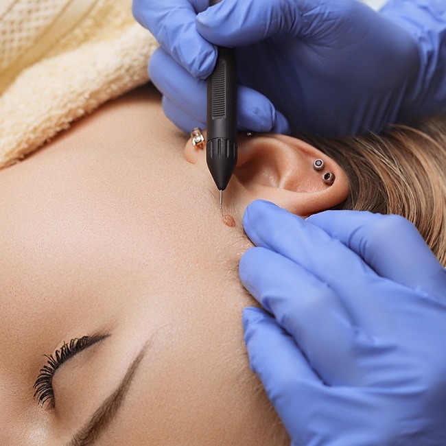 Woman undergoing mole removal treatment