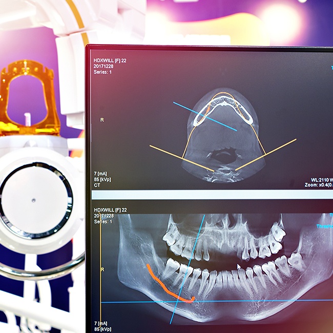 C T scan guided surgery plan