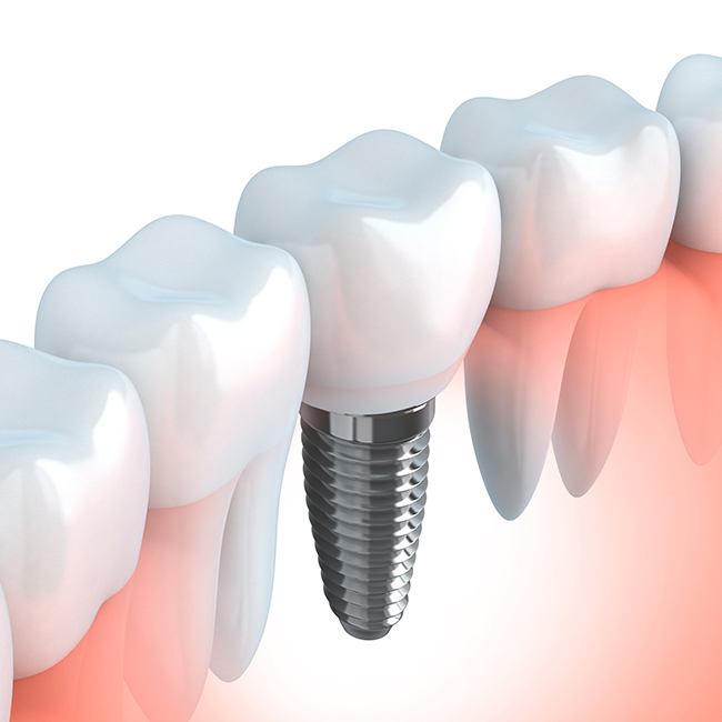 Animated smile with dental implant supported dental crown