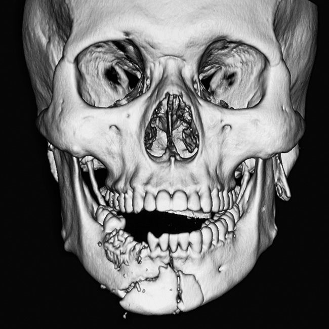 3 D image of face after bone injury in the jaw