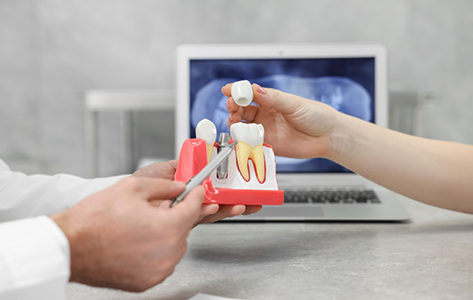 Dentist showing a model of a dental implant to a patient