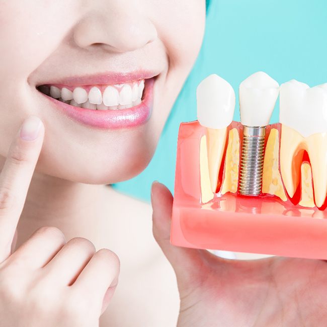woman pointing to smile holding model dental implant