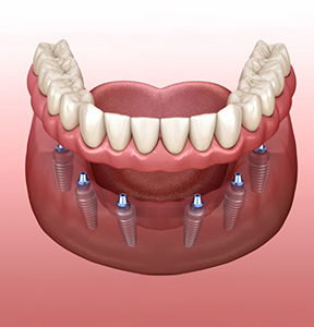 Illustration of a ful  denture being placed over six dental implants