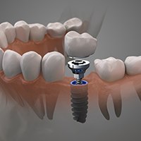 3D illustration of single tooth dental implant