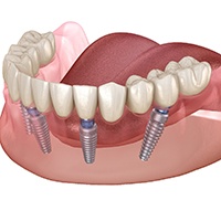 Diagram showing how implant dentures in Houston work
