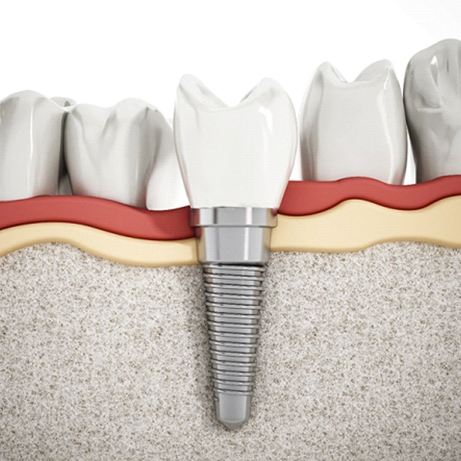 Illustrated cross section of dental implant in Houston among natural teeth