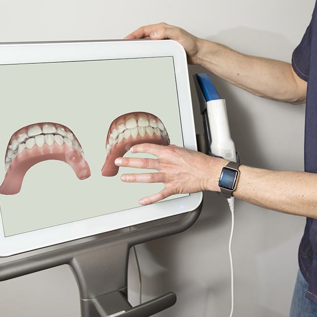 Intraoral digital impression scans on computer