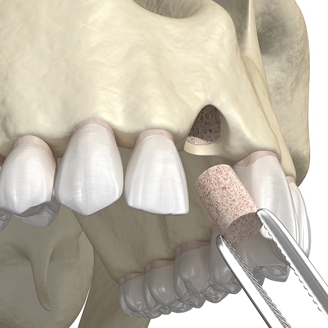 Animated smile during bone grafting