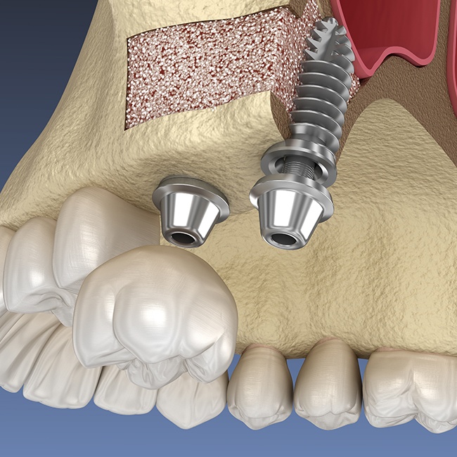 Animated smile during tissue and bone grafting treatment