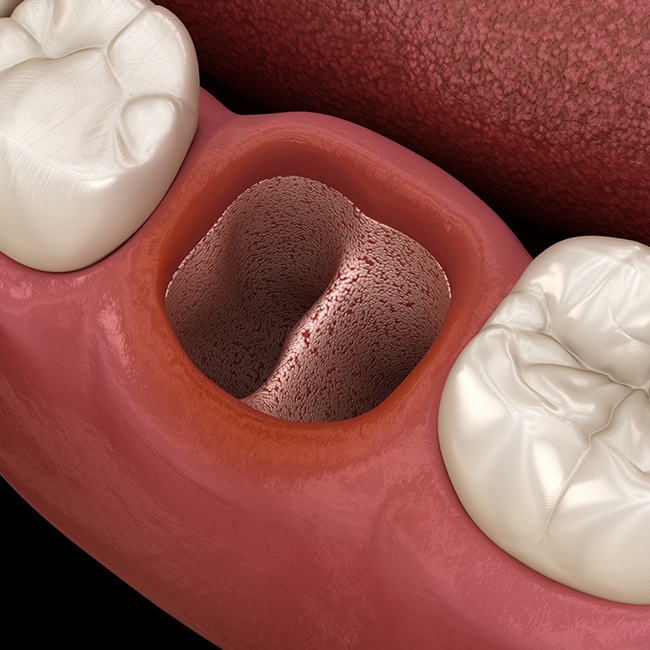 Animated smile with dry socket after blood clot is dislodged