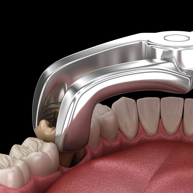 Animated smile during tooth extraction