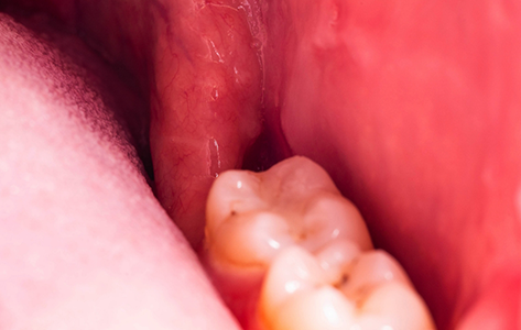 Close up of an empty socket after a tooth extraction