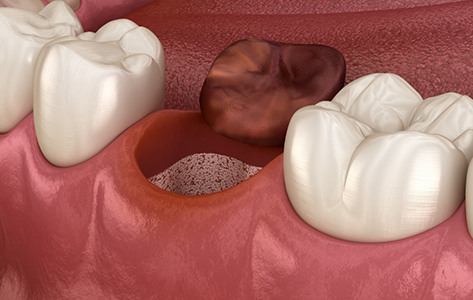 Illustration of a blood clot coming off of a tooth extraction site