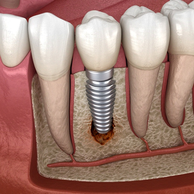 Illustration of peri-implantitis, a common cause of dental implant failure