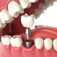 Illustration of implant, abutment, and crown amongst natural teeth