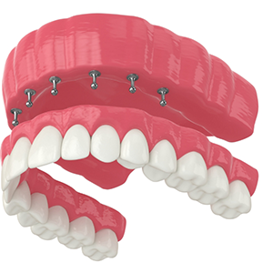 Illustration of a denture being secured onto ball shaped attachments on dental implants