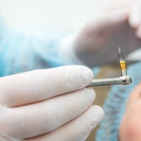 Oral surgeon preparing to place dental implant in patient’s mouth