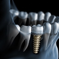 Illustration of implant that has integrated with surrounding bone