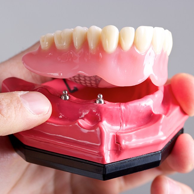 Model smile with dental implant supported denture