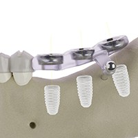 Side view of surgical guide used during dental implant surgery