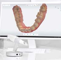3D digital dental impression displayed on computer monitor