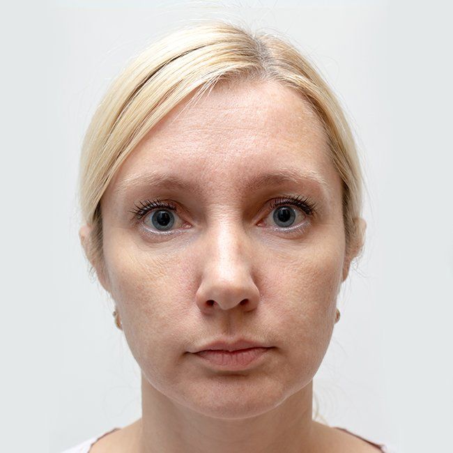 Woman before Juvederm treatment