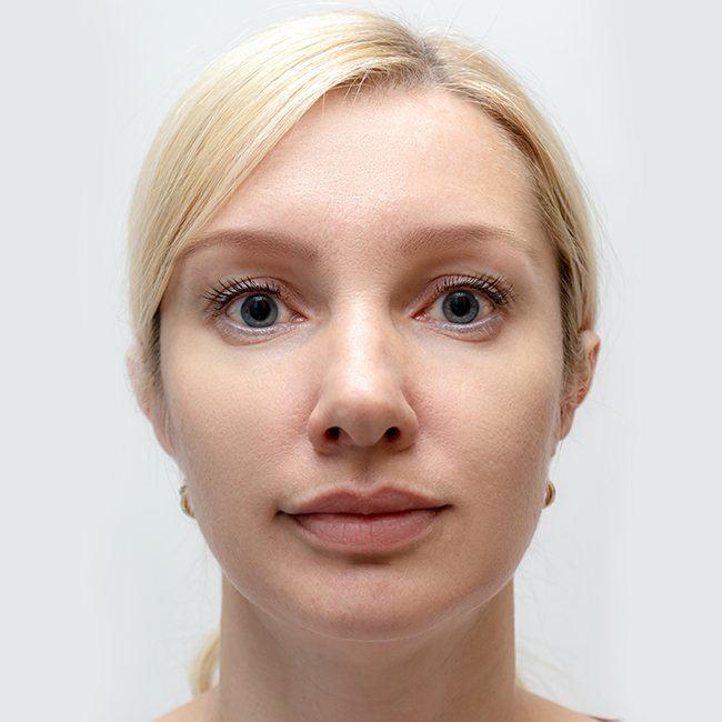 Woman's flawless new look after Juvederm treatment