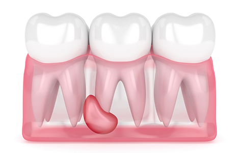 Illustration of a small cyst at the root of a tooth