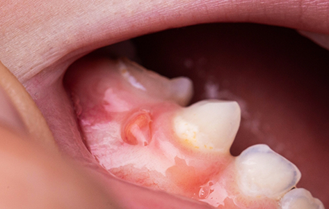 Close up of a small cyst in the gums